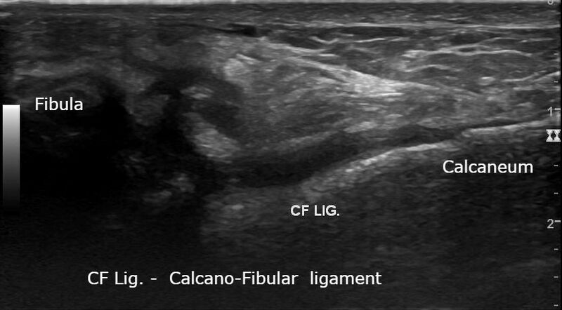 File:Anterior talofibular ligament injury (Radiopaedia 59447).jpg