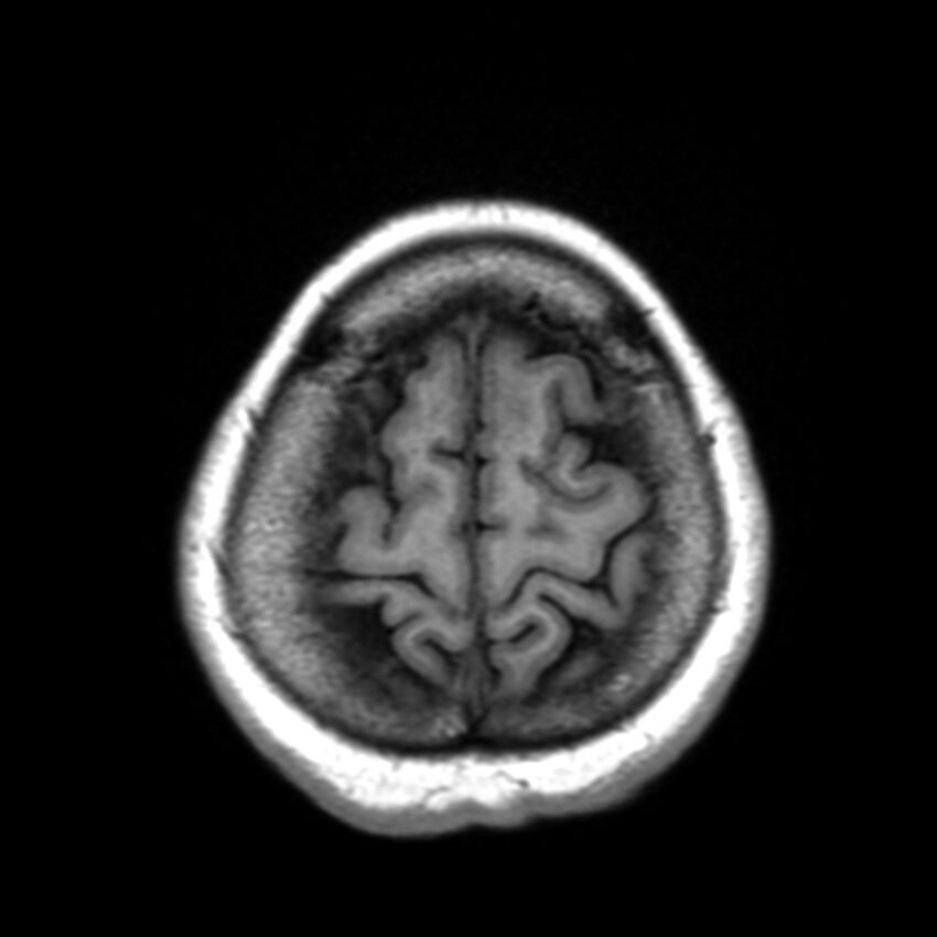 Anti-MOG encephalomyelitis (Radiopaedia 73831-84646 Axial T1 44).jpg