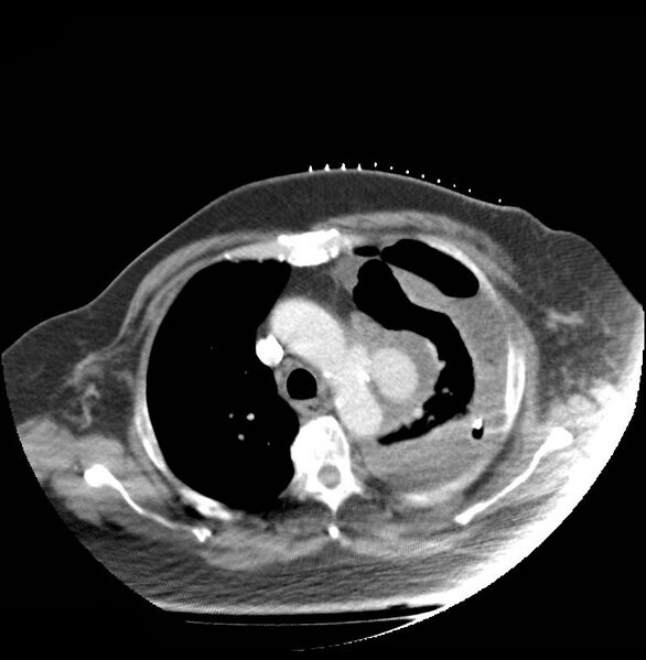 File:Aortic arch false aneurysm (Radiopaedia 14667-14588 A 7).jpg