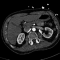 Aortic dissection - DeBakey type II (Radiopaedia 64302-73082 A 99).png