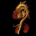Aortic dissection with rupture into pericardium (Radiopaedia 12384-12647 D 32).jpg