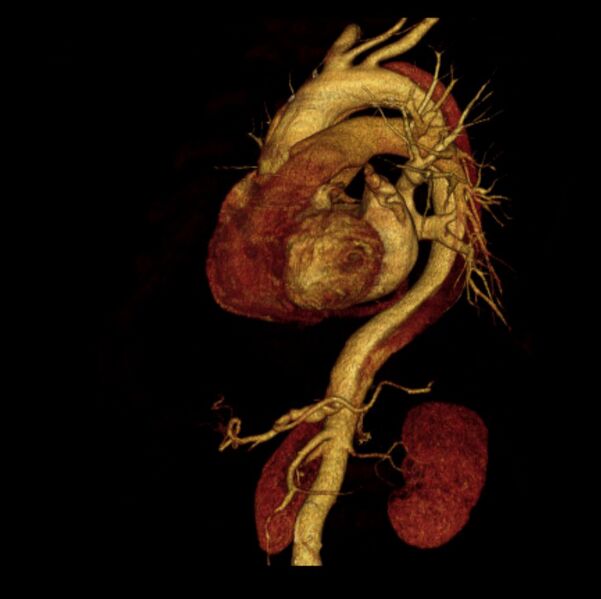 File:Aortic dissection with rupture into pericardium (Radiopaedia 12384-12647 D 32).jpg