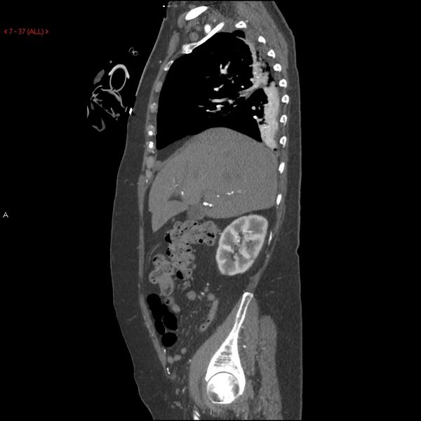 File:Aortic intramural hematoma (Radiopaedia 27746-28001 C 6).jpg