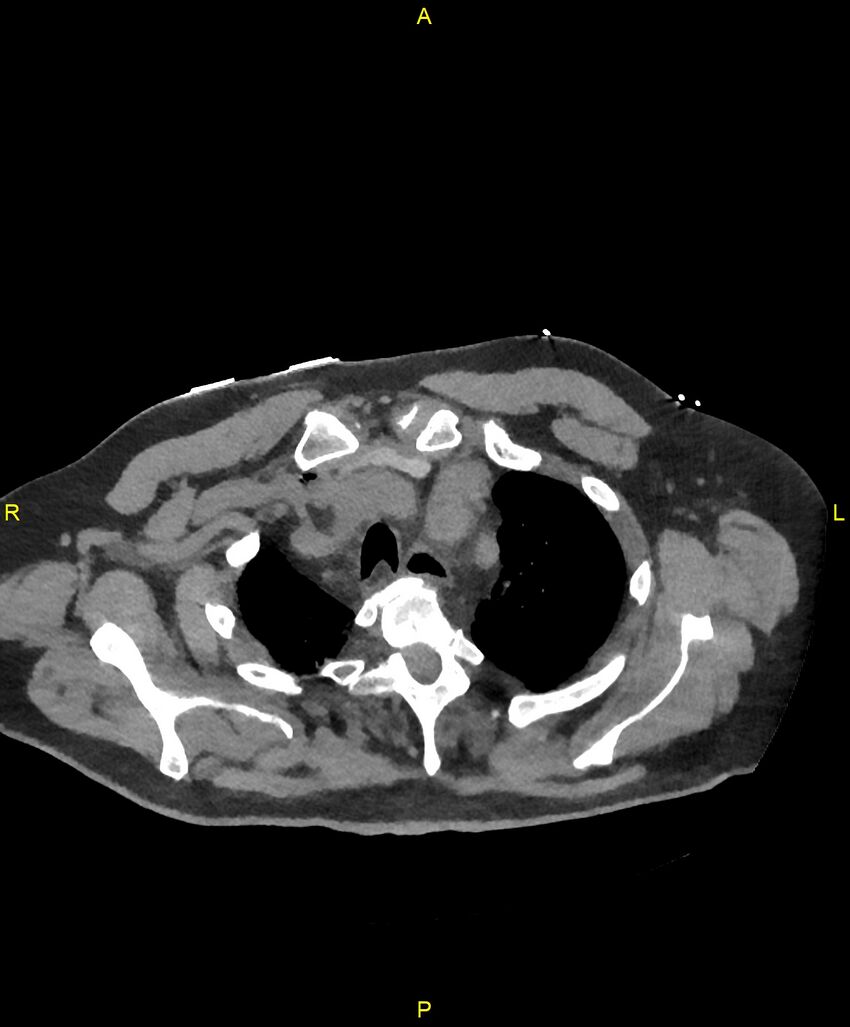 Aortic rupture (Radiopaedia 88822-105594 Axial non-contrast 27).jpg