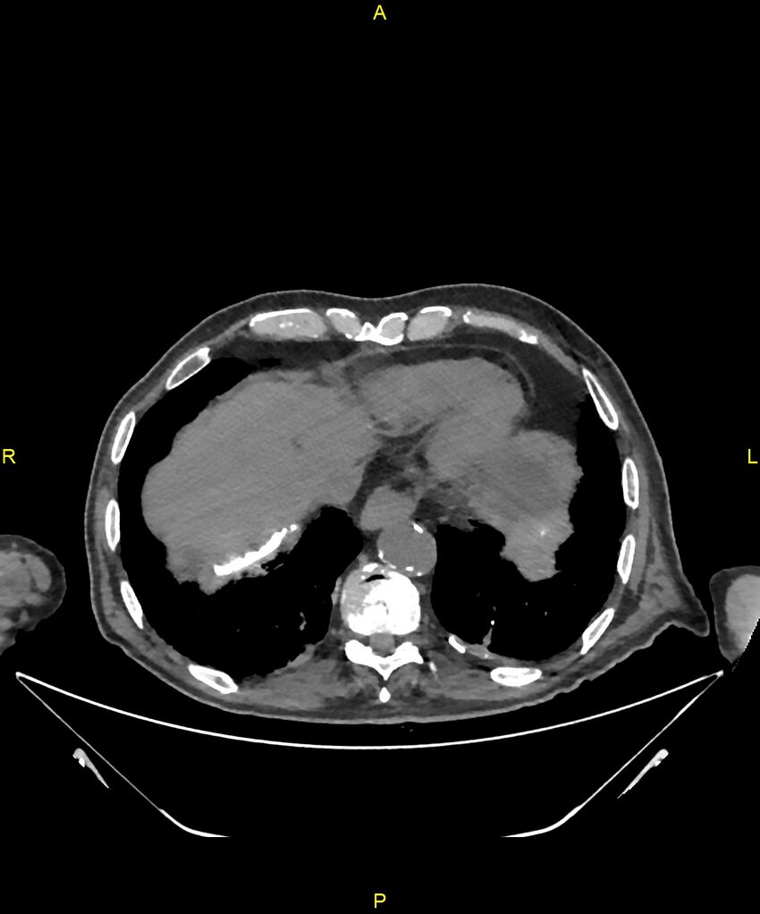 Aortoenteric fistula (Radiopaedia 84308-99603 Axial non-contrast 16).jpg