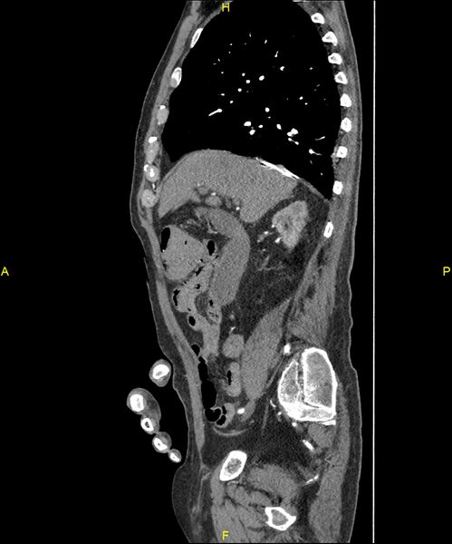 File:Aortoenteric fistula (Radiopaedia 84308-99603 C 120).jpg