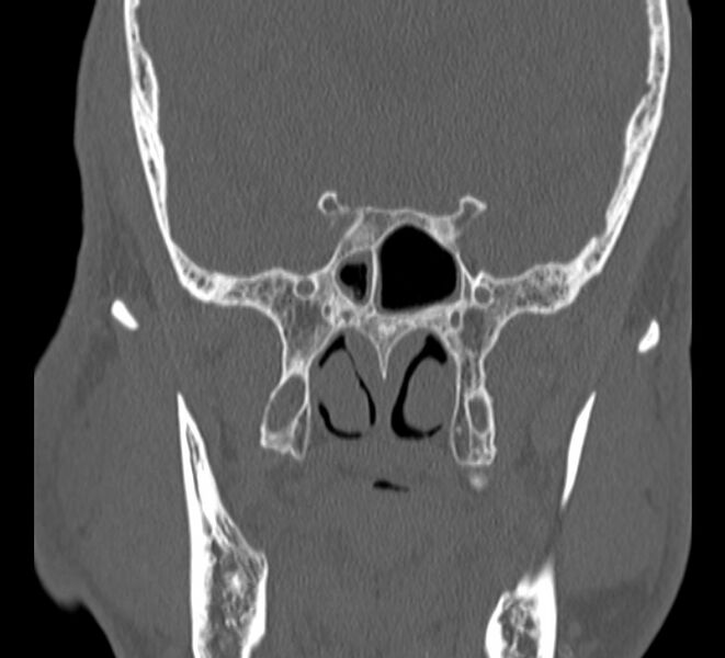 File:Aplastic maxillary sinuses (Radiopaedia 60030-67561 Coronal non-contrast 31).jpg