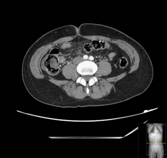 File:Appendicitis (CT angiogram) (Radiopaedia 154713-127660 Axial 47).jpg