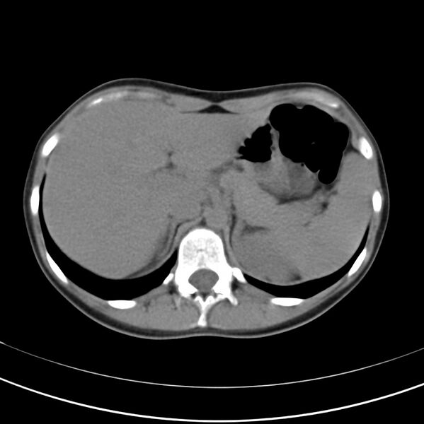 File:Appendicitis and incidental bicornuate uterus (Radiopaedia 22833-22853 Axial non-contrast 11).jpg