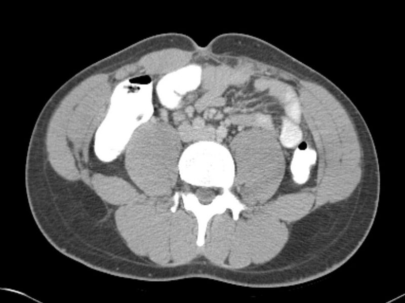 File:Appendicitis and incidental foregut duplication cyst (Radiopaedia 52962-58916 A 47).jpg