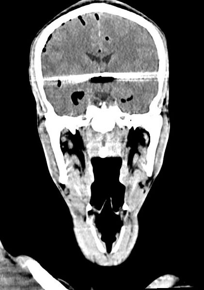 File:Arrow injury to the brain (Radiopaedia 72101-82607 Coronal non-contrast 39).jpg