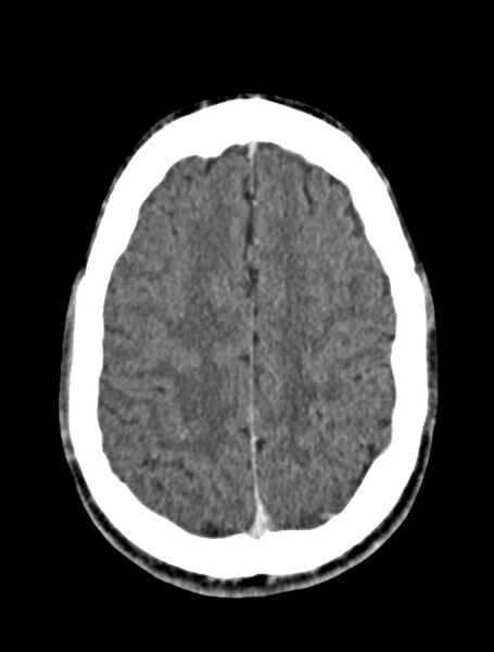 File:Arrow injury to the face (Radiopaedia 73267-84011 Axial C+ delayed 68).jpg