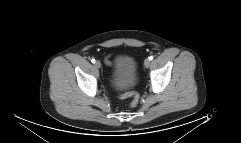 File:Arterial occlusive mesenteric ischemia (Radiopaedia 84641-100060 A 115).jpg