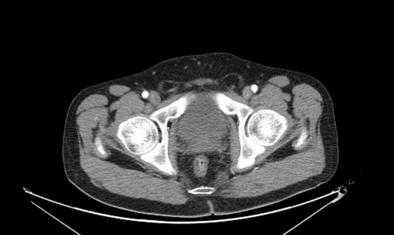 File:Arterial occlusive mesenteric ischemia (Radiopaedia 84641-100060 A 126).jpg