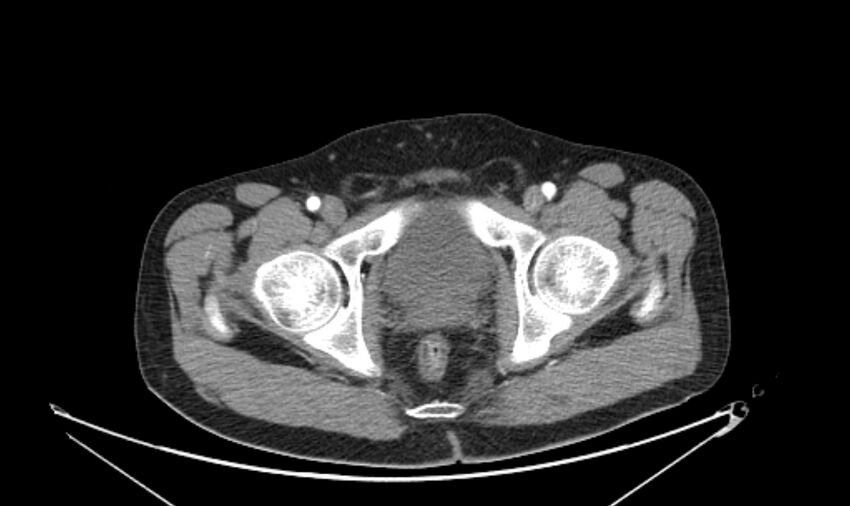 Arterial occlusive mesenteric ischemia (Radiopaedia 84641-100060 A 126).jpg