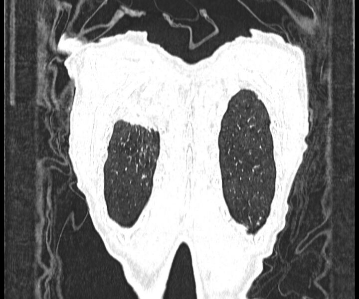File:Aspergillomas (Radiopaedia 66779-76110 Coronal lung window 21).jpg