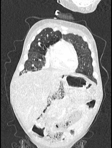 File:Asplenia syndrome (Radiopaedia 73083-83792 Coronal lung window 25).jpg