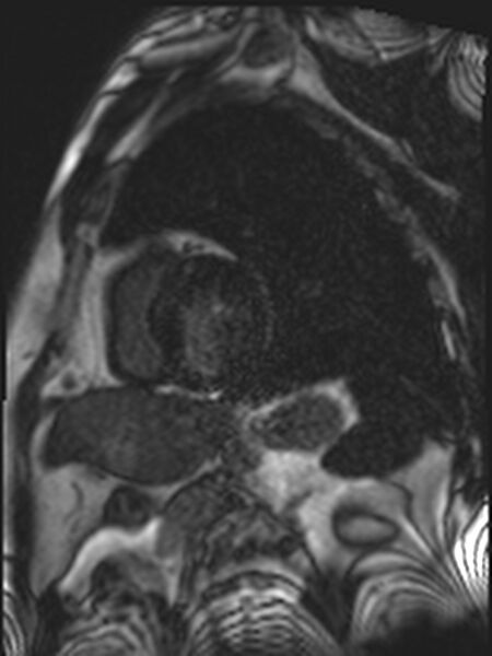 File:Asymmetric septal hypertrophic cardiomyopathy - systolic anterior motion of mitral leaflet (Radiopaedia 72795-83445 D 5).jpg