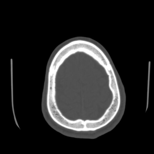 File:Asymptomatic occipital spur (Radiopaedia 87753-104201 Axial bone window 185).jpg