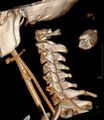 Atlanto-occipital dislocation (Radiopaedia 44648-48412 3D reconstruction 1).jpg