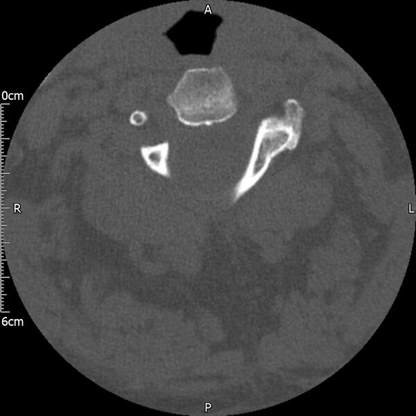 File:Atlas fracture with Currarino type A congenital defect (Radiopaedia 71747-82144 Axial bone window 64).jpg