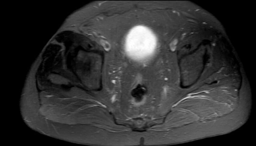Atypical lipomatous tumor - thigh (Radiopaedia 68975-78734 Axial PD fat sat 99).jpg