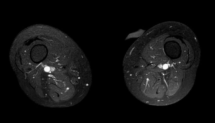 Atypical lipomatous tumor - thigh (Radiopaedia 68975-78734 Axial T1 C+ fat sat 30).jpg