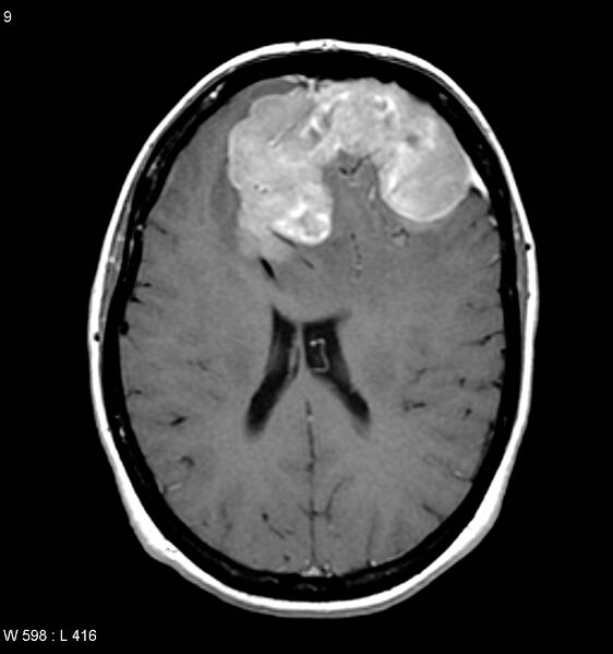 File:Atypical meningioma (WHO grade II) (Radiopaedia 7762-8586 D 5).jpg