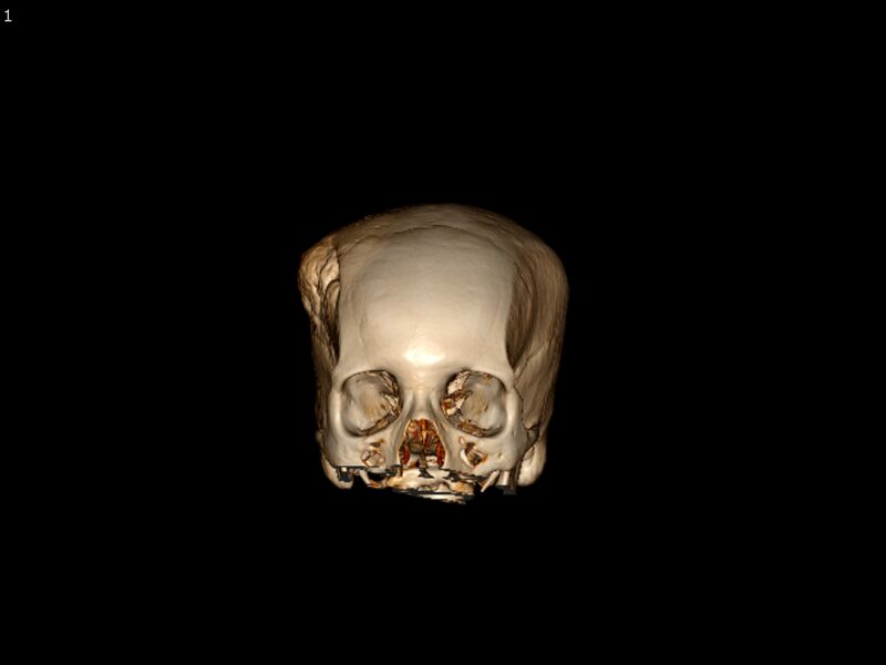 File:Atypical meningioma - intraosseous (Radiopaedia 64915-73867 3D volume render 1).jpg