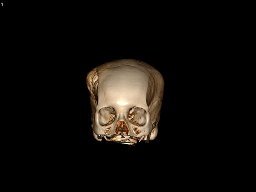 Atypical meningioma - intraosseous (Radiopaedia 64915-73867 3D volume render 1).jpg