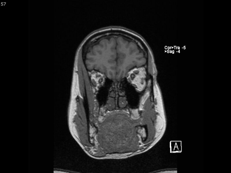 File:Atypical meningioma - intraosseous (Radiopaedia 64915-74572 Coronal T1 57).jpg