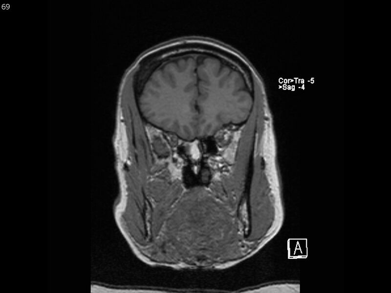 File:Atypical meningioma - intraosseous (Radiopaedia 64915-74572 Coronal T1 69).jpg