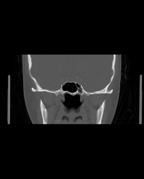 File:Automastoidectomy with labyrinthine fistula (Radiopaedia 84143-99411 Coronal non-contrast 70).jpg