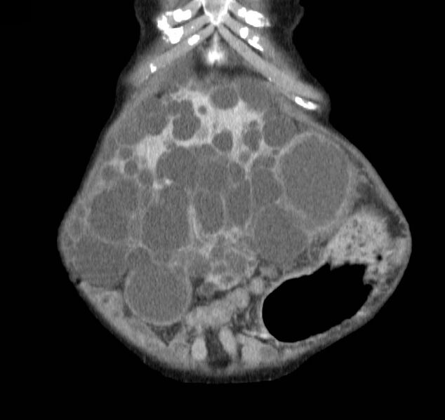 File:Autosomal dominant polycystic kidney disease (Radiopaedia 16777-16490 B 4).jpg