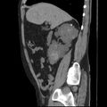 Autosomal dominant polycystic kidney disease (Radiopaedia 36539-38101 D 30).jpg