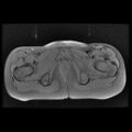 Avascular necrosis of the hip (Radiopaedia 29563-30067 Axial T1 fat sat 13).jpg