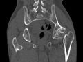 Avascular necrosis of the left hip (Radiopaedia 75068-86125 Coronal bone window 61).jpg