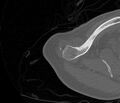 Avulsion fracture - greater tuberosity of humerus (Radiopaedia 71216-81514 Axial bone window 7).jpg
