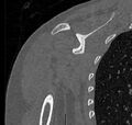 Avulsion fracture - greater tuberosity of humerus (Radiopaedia 71216-81514 Coronal bone window 45).jpg