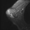 Avulsion fracture - greater tuberosity of humerus (Radiopaedia 71216-81515 Axial PD fat sat 19).jpg