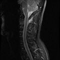 Axis fracture - MRI (Radiopaedia 71925-82375 Sagittal STIR 5).jpg