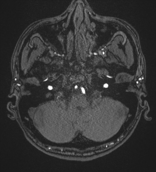 File:Basal ganglia subacute infarct (Radiopaedia 80201-93521 Axial MRA 2).png
