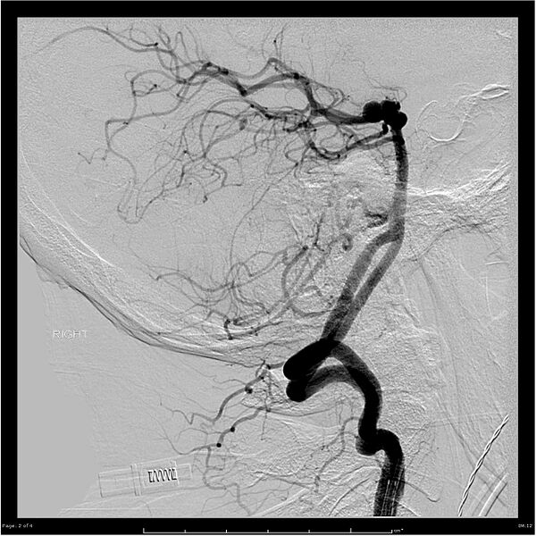 File:Basilar tip aneurysm double balloon remodeling (Radiopaedia 18100-17883 B 1).jpg