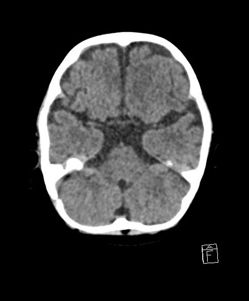File:Benign enlargement of subarachnoid spaces in infancy (BESS) (Radiopaedia 87459-103795 Axial non-contrast 65).jpg
