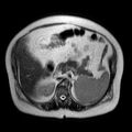 Benign seromucinous cystadenoma of the ovary (Radiopaedia 71065-81300 Axial T2 13).jpg