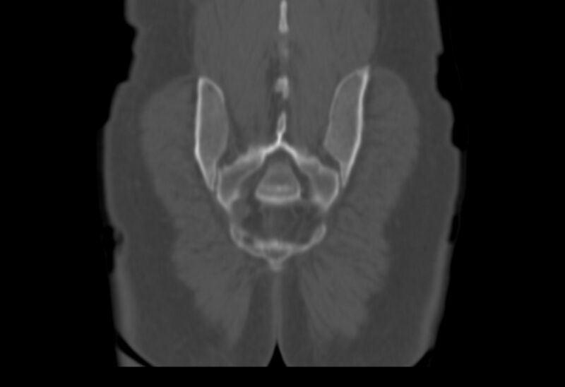 File:Bertolotti syndrome (Radiopaedia 58974-66235 Coronal bone window 3).jpg