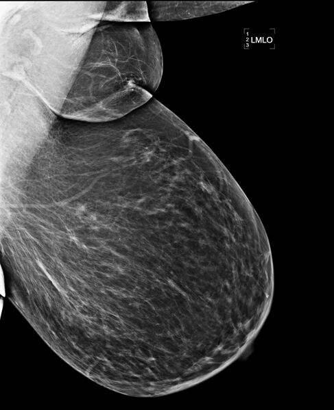 File:Bilateral accessory breast tissue (Radiopaedia 54239-60437 Left MLO 1).jpg