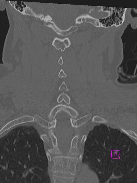File:Bilateral atlanto-occipital assimilation (Radiopaedia 28350-28603 Coronal bone window 30).jpg