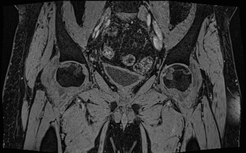 File:Bilateral avascular necrosis of femoral head (Radiopaedia 77116-89078 Coronal T2 we 50).jpg