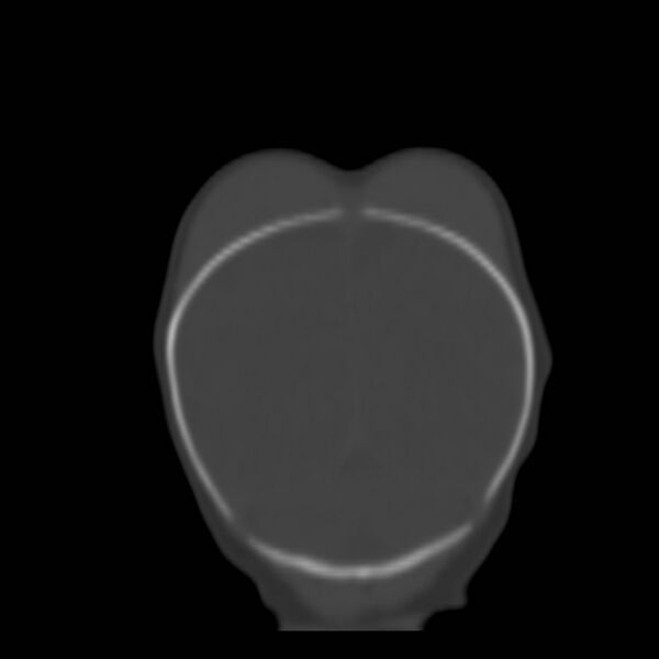 File:Bilateral cephalohematomas and subdural hematomas (Radiopaedia 26778-26929 Coronal bone window 27).jpg